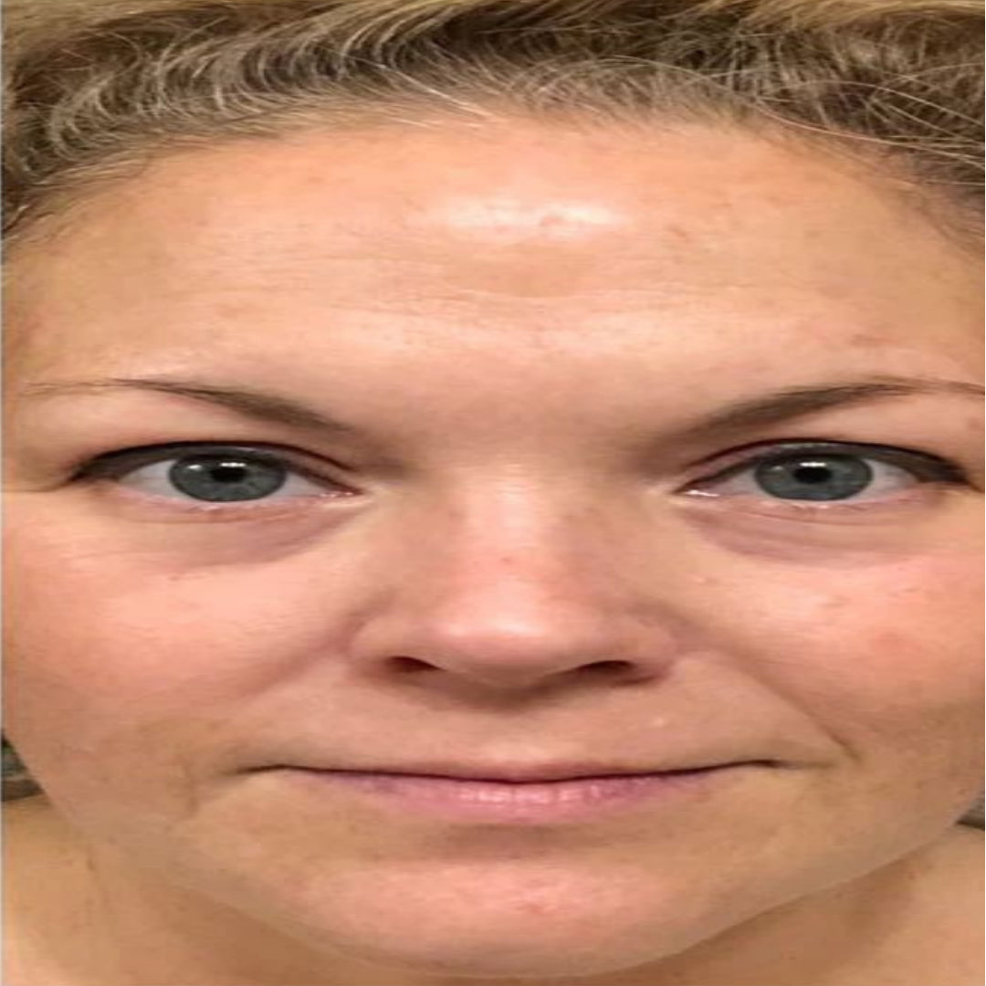 DESPUÉS